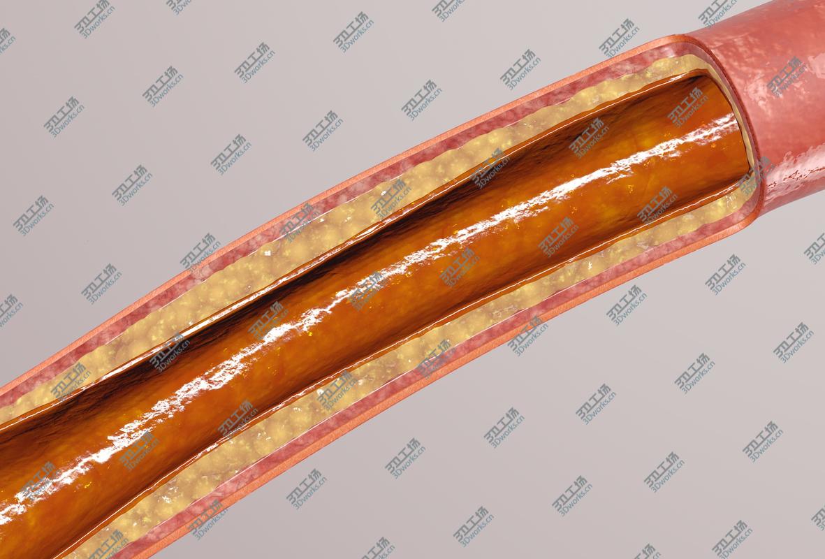 images/goods_img/2021040232/blocked blood vessel animation 3D model/5.jpg